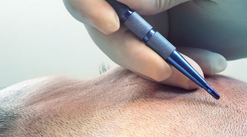 Dernières nouvelles de l'entreprise Application des lames de saphir dans la chirurgie de greffe de cheveux